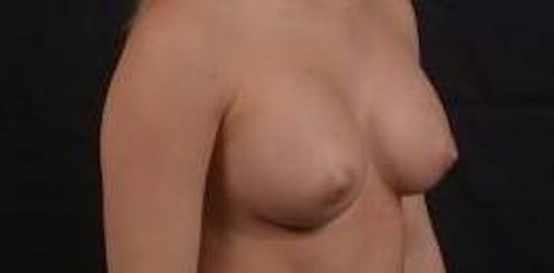 Breast Augmentation Silicone Gel Before & After Gallery - Patient 398485 - Image 10
