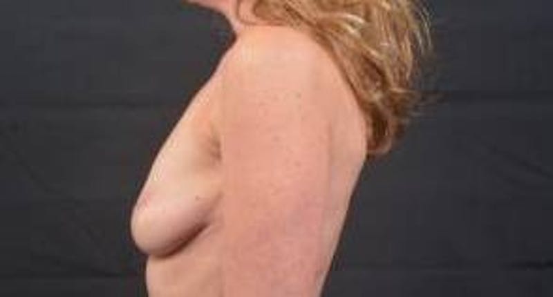 Breast Augmentation Silicone Gel Before & After Gallery - Patient 319826 - Image 3