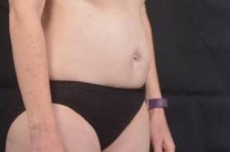 Abdominoplasty Before & After Gallery - Patient 297964 - Image 9