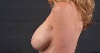 Breast Augmentation Silicone Gel Before & After Gallery - Patient 319826 - Image 4