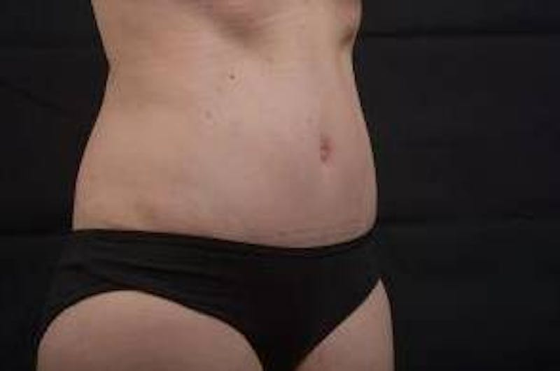Abdominoplasty Before & After Gallery - Patient 297964 - Image 10