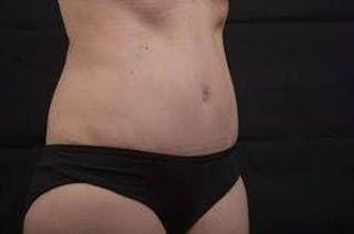 Abdominoplasty Before & After Gallery - Patient 297964 - Image 10