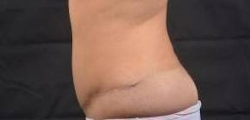 Abdominoplasty Before & After Gallery - Patient 170814 - Image 3