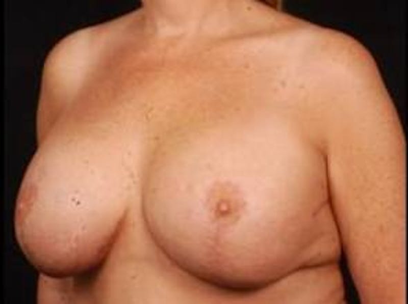 Aesthetic Breast Revision Before & After Gallery - Patient 425515 - Image 4