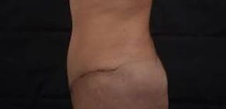 Abdominoplasty Before & After Gallery - Patient 170814 - Image 4