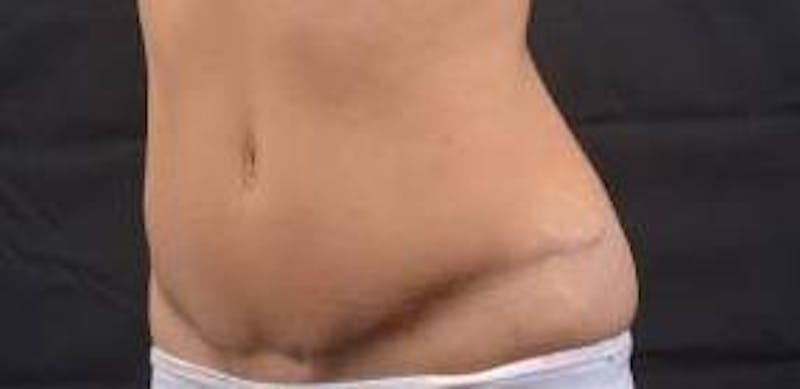 Abdominoplasty Before & After Gallery - Patient 170814 - Image 5