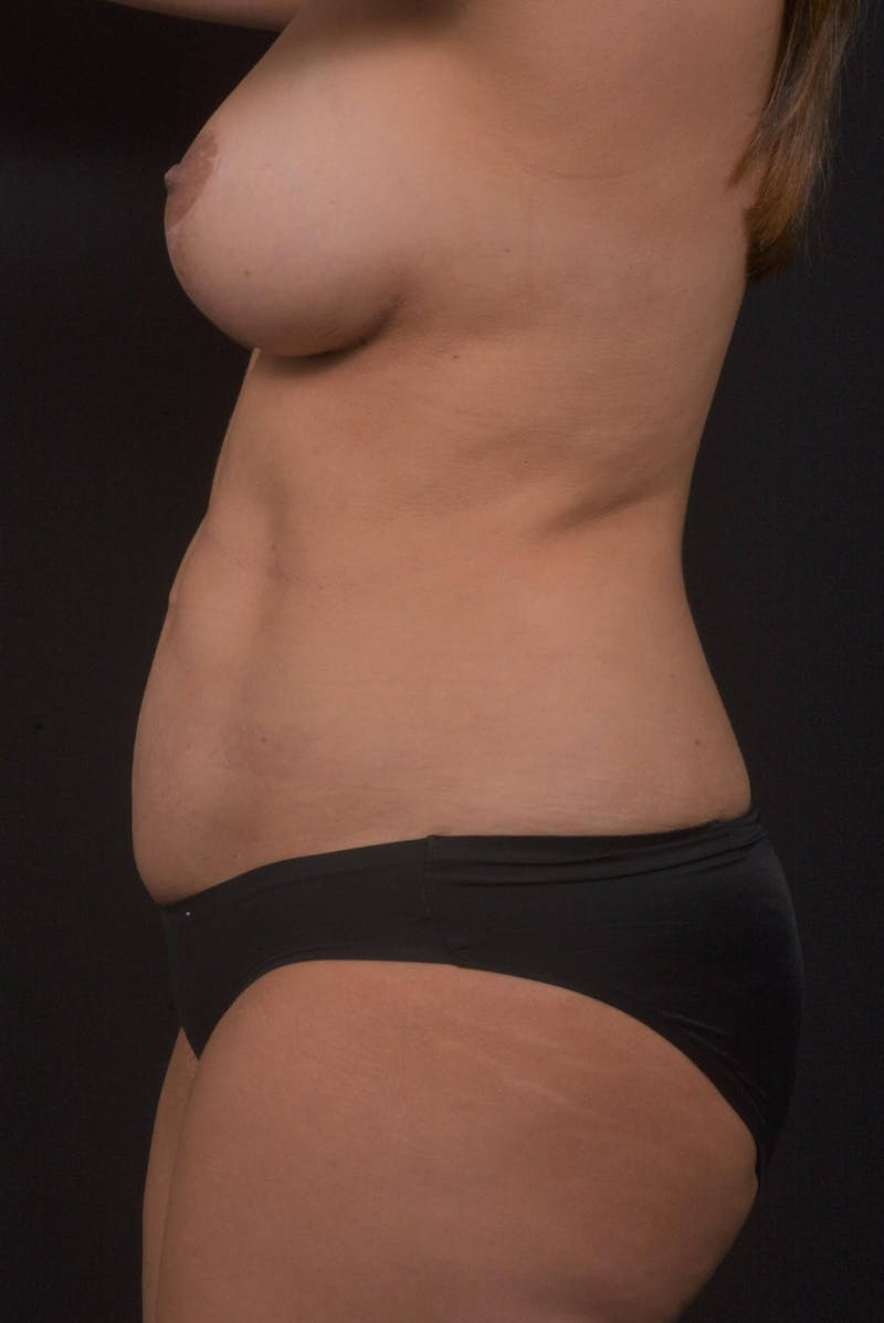 Mommy Makeover Before & After Gallery - Patient 895854 - Image 4