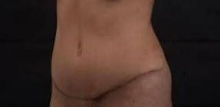 Abdominoplasty Before & After Gallery - Patient 170814 - Image 6