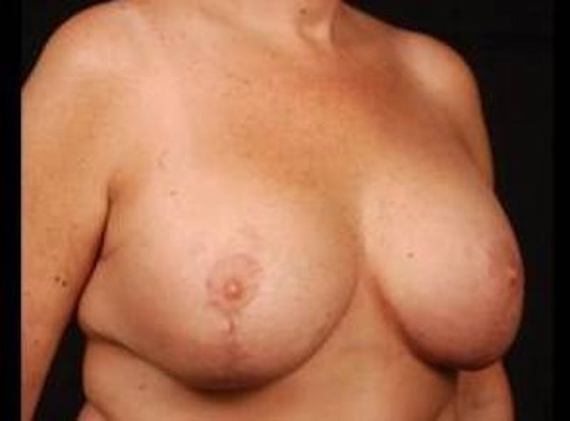 Aesthetic Breast Revision Before & After Gallery - Patient 425515 - Image 6