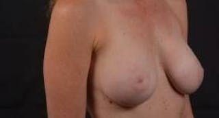 Breast Augmentation Silicone Gel Before & After Gallery - Patient 319826 - Image 10