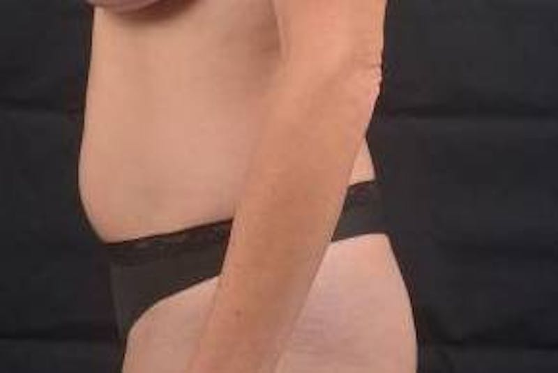 Abdominoplasty Before & After Gallery - Patient 436118 - Image 3