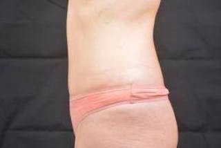 Abdominoplasty Before & After Gallery - Patient 436118 - Image 4