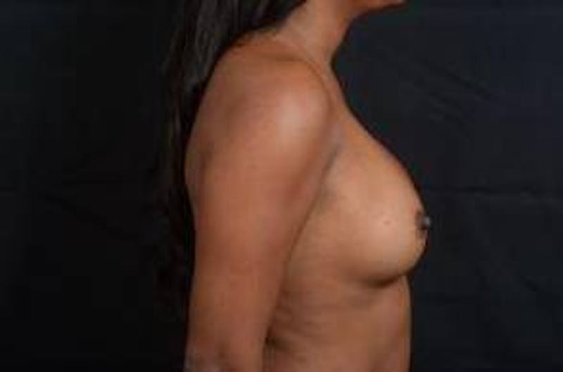 Aesthetic Breast Revision Before & After Gallery - Patient 233012 - Image 5