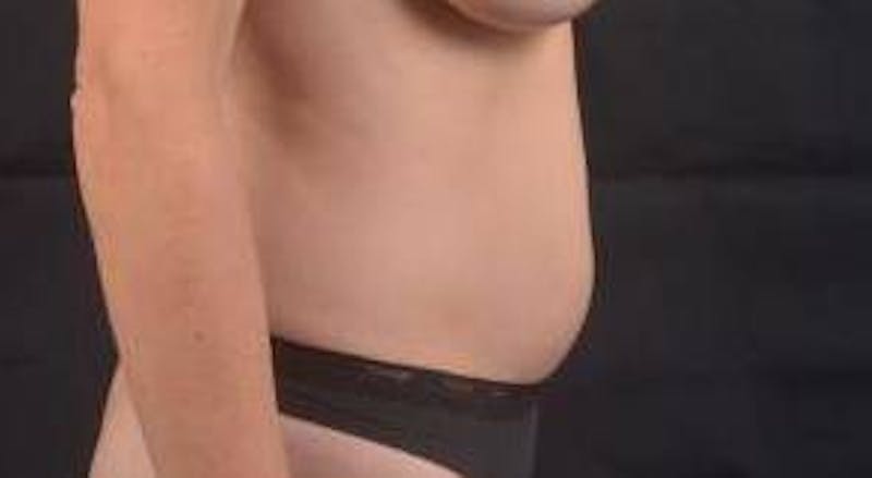 Abdominoplasty Before & After Gallery - Patient 436118 - Image 5