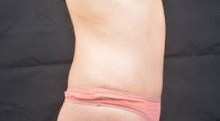 Abdominoplasty Before & After Gallery - Patient 436118 - Image 6