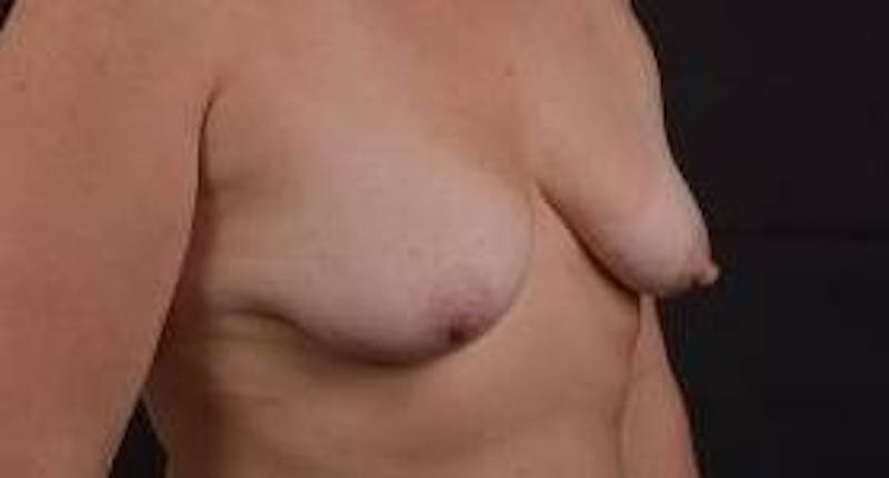 Breast Augmentation Silicone Gel Before & After Gallery - Patient 288479 - Image 5