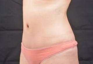 Abdominoplasty Before & After Gallery - Patient 436118 - Image 8