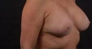 Breast Augmentation Silicone Gel Before & After Gallery - Patient 288479 - Image 6
