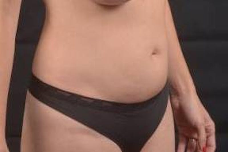 Abdominoplasty Before & After Gallery - Patient 436118 - Image 9