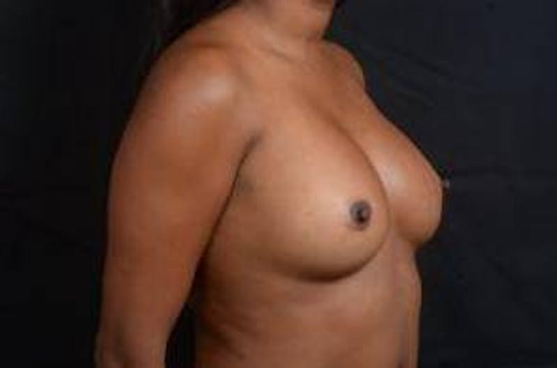 Aesthetic Breast Revision Before & After Gallery - Patient 233012 - Image 9