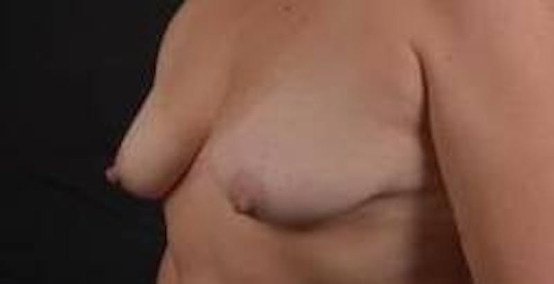 Breast Augmentation Silicone Gel Before & After Gallery - Patient 288479 - Image 7