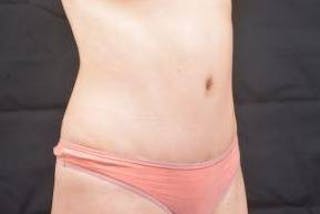 Abdominoplasty Before & After Gallery - Patient 436118 - Image 10