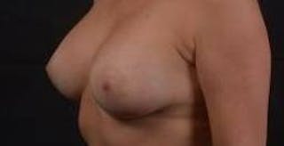 Breast Augmentation Silicone Gel Before & After Gallery - Patient 288479 - Image 8