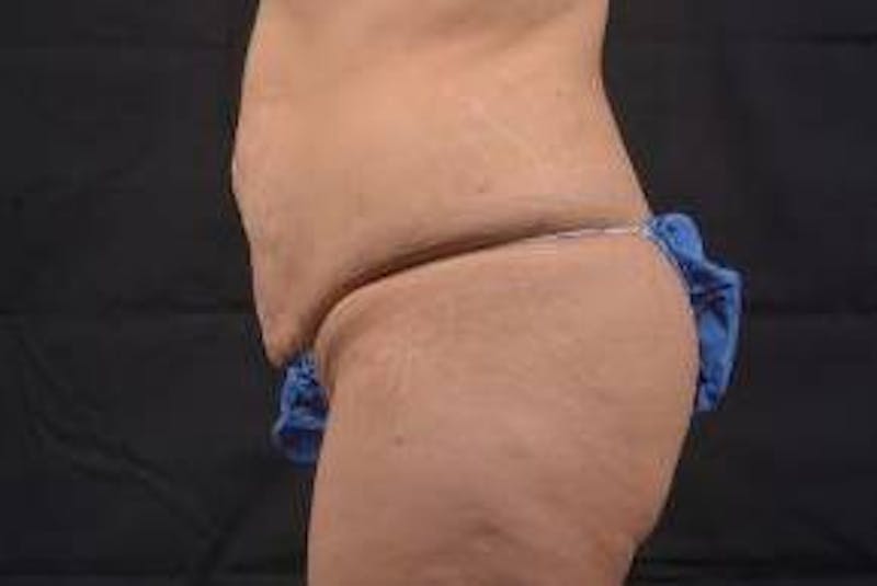 Abdominoplasty Before & After Gallery - Patient 117112 - Image 3
