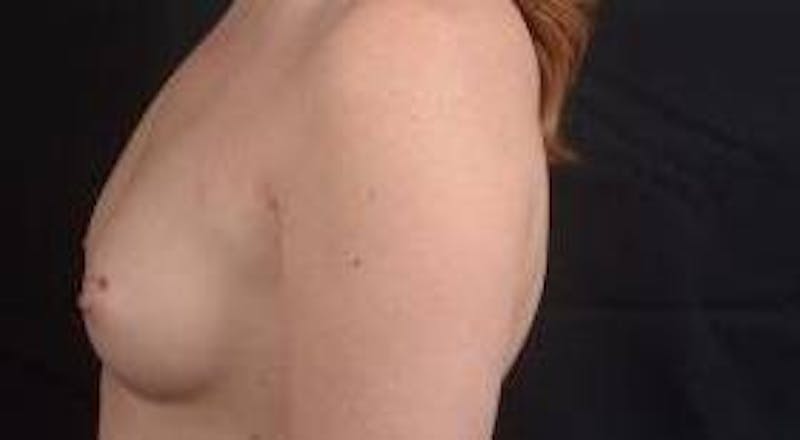 Breast Augmentation Silicone Gel Before & After Gallery - Patient 267112 - Image 3
