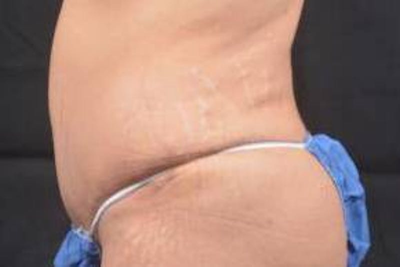Abdominoplasty Before & After Gallery - Patient 117112 - Image 4