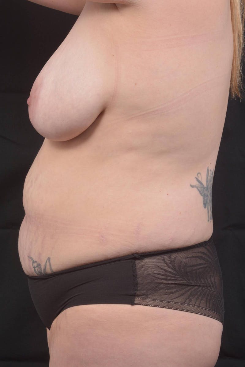 Mommy Makeover Before & After Gallery - Patient 180044 - Image 3