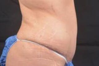 Abdominoplasty Before & After Gallery - Patient 117112 - Image 6