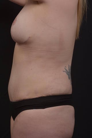 Mommy Makeover Before & After Gallery - Patient 180044 - Image 4