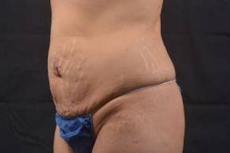 Abdominoplasty Before & After Gallery - Patient 117112 - Image 7