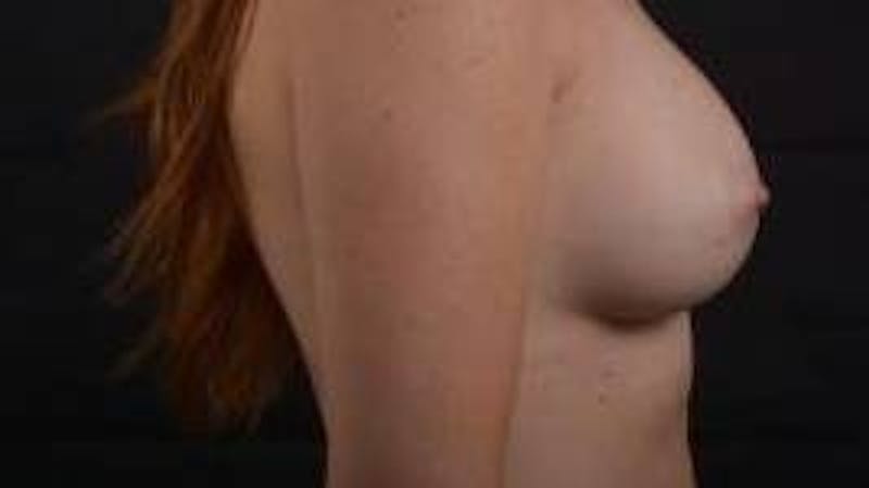 Breast Augmentation Silicone Gel Before & After Gallery - Patient 267112 - Image 6