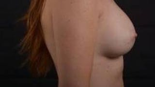 Breast Augmentation Silicone Gel Before & After Gallery - Patient 267112 - Image 6