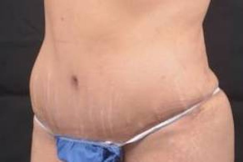 Abdominoplasty Before & After Gallery - Patient 117112 - Image 8