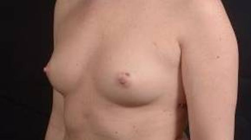 Breast Augmentation Silicone Gel Before & After Gallery - Patient 267112 - Image 7