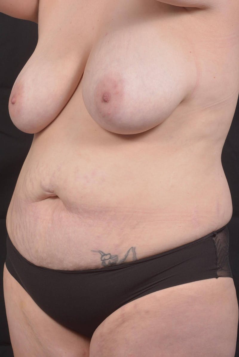 Mommy Makeover Before & After Gallery - Patient 180044 - Image 7
