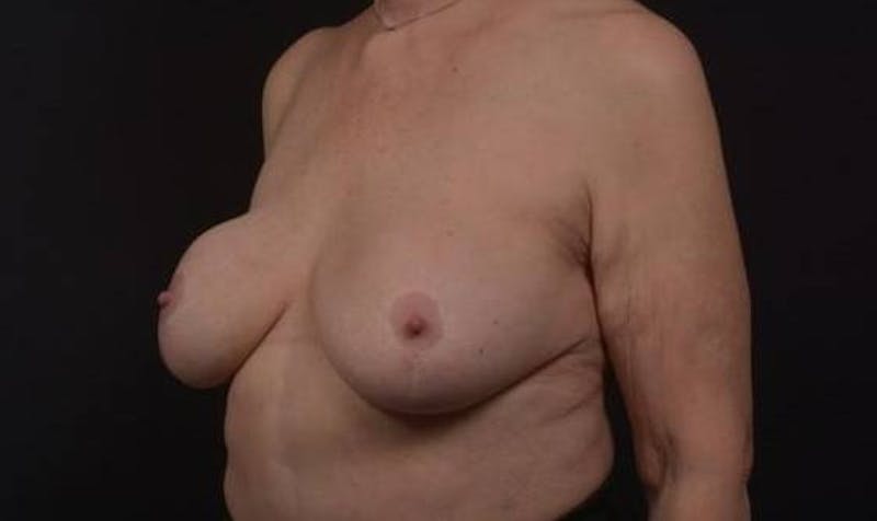 Aesthetic Breast Revision Before & After Gallery - Patient 146385 - Image 3