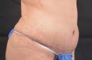 Abdominoplasty Before & After Gallery - Patient 117112 - Image 10