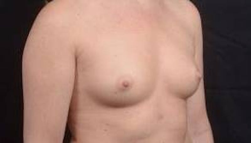 Breast Augmentation Silicone Gel Before & After Gallery - Patient 267112 - Image 9