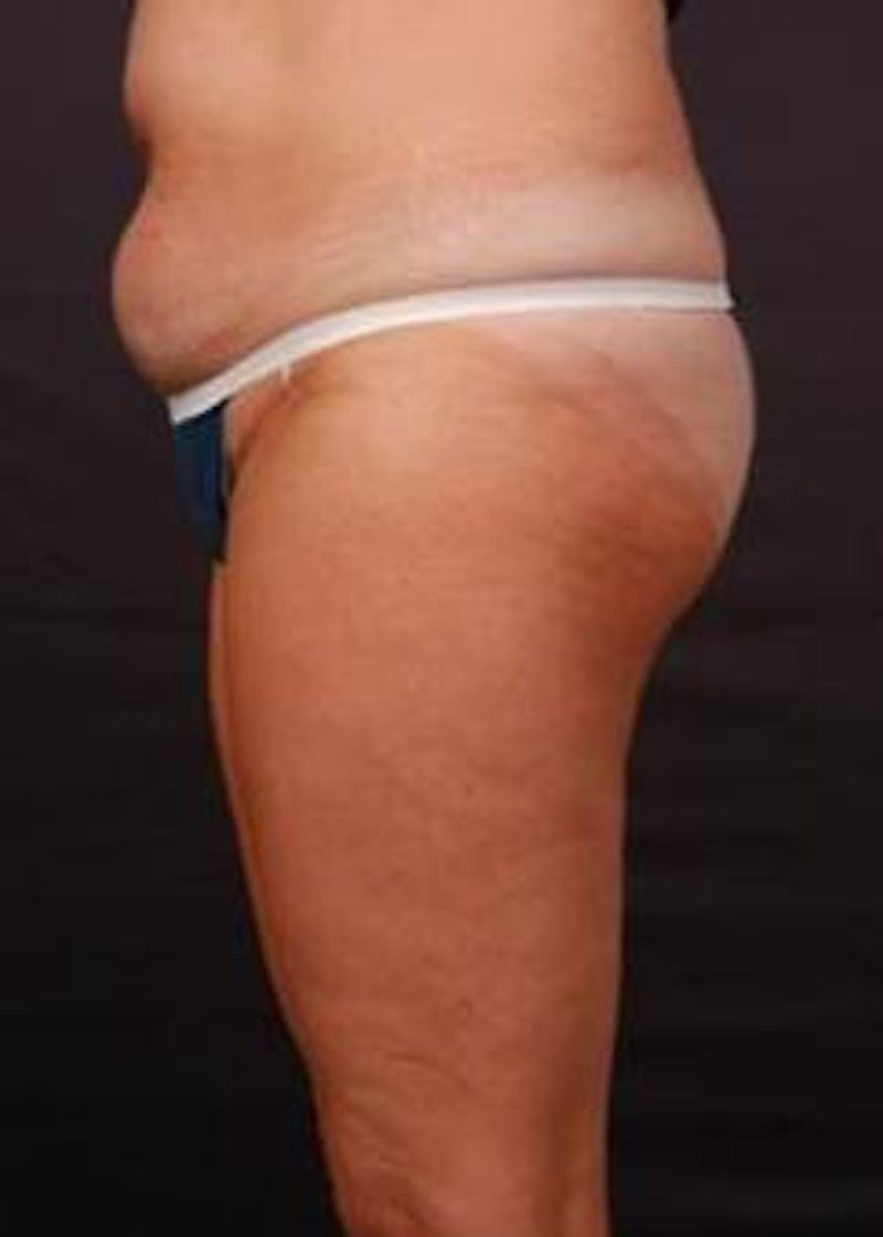 Abdominoplasty Before & After Gallery - Patient 199110 - Image 3