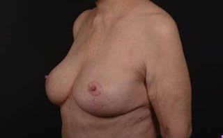Aesthetic Breast Revision Before & After Gallery - Patient 146385 - Image 4