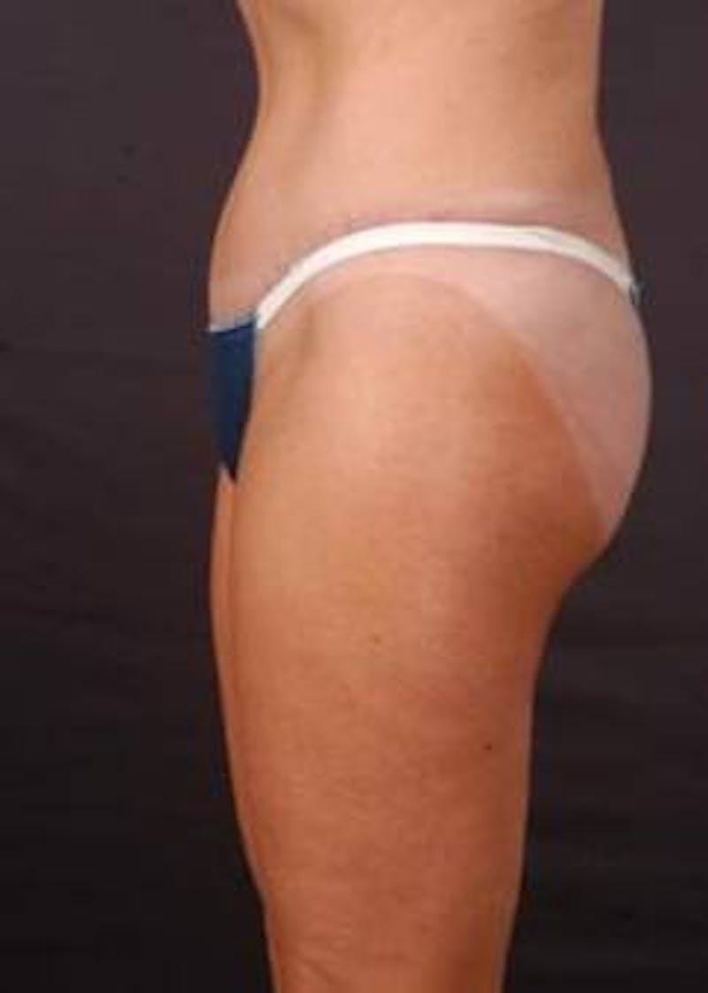 Abdominoplasty Before & After Gallery - Patient 199110 - Image 4