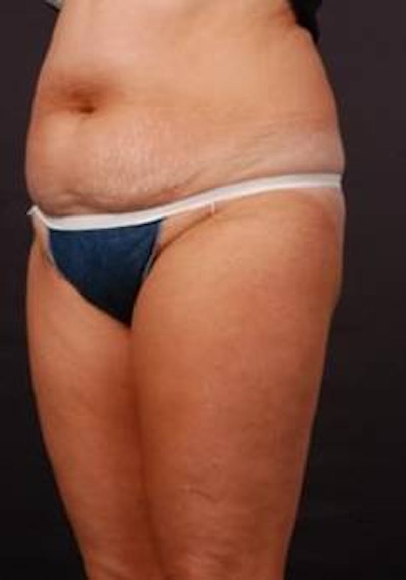 Abdominoplasty Before & After Gallery - Patient 199110 - Image 5