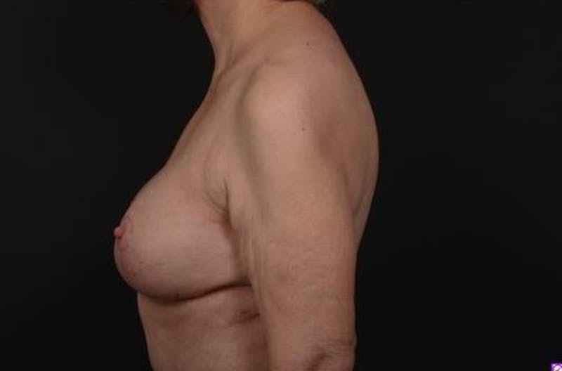 Aesthetic Breast Revision Before & After Gallery - Patient 146385 - Image 6