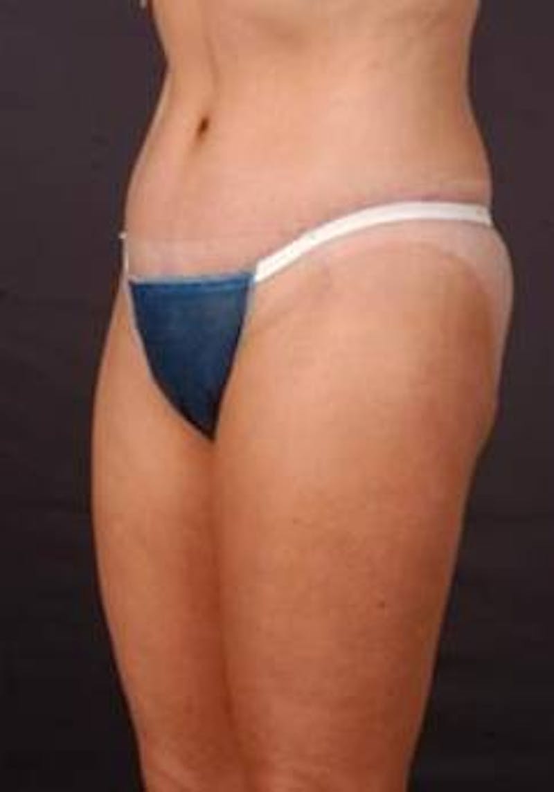 Abdominoplasty Before & After Gallery - Patient 199110 - Image 6