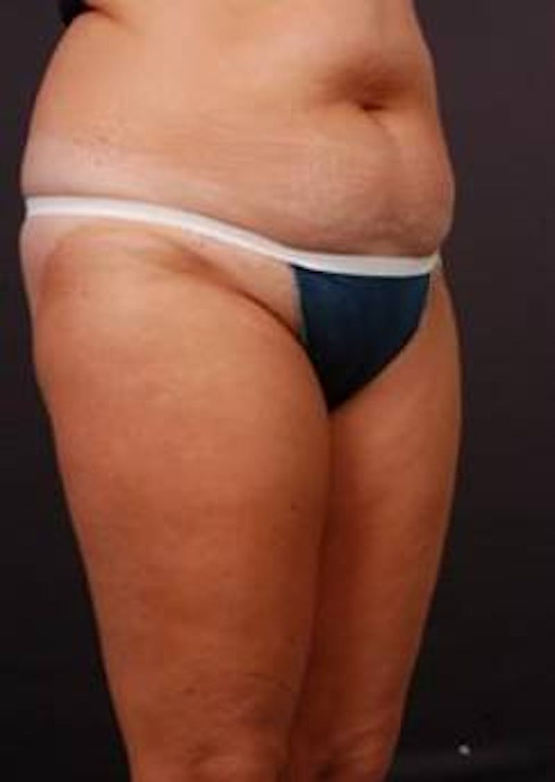Abdominoplasty Before & After Gallery - Patient 199110 - Image 7
