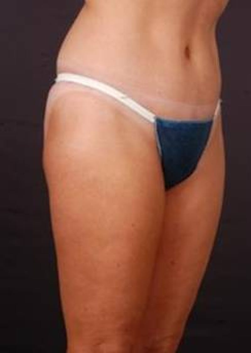 Abdominoplasty Before & After Gallery - Patient 199110 - Image 8